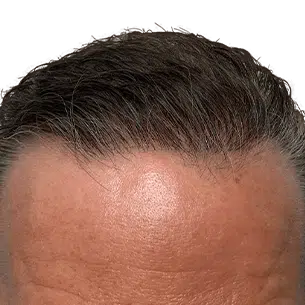 Before After 1