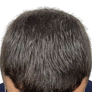 Before After 1