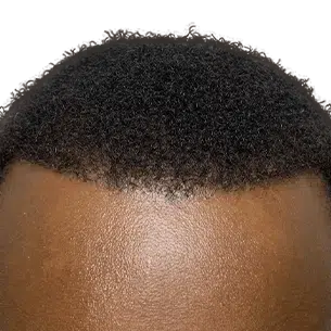 Before After 1