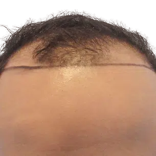 Before After 0