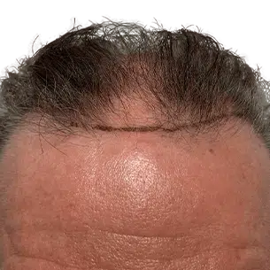 Before After 0