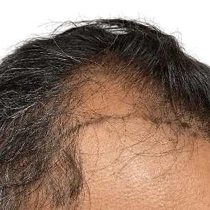 Before After 2