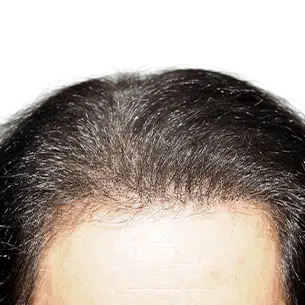 Before After 1