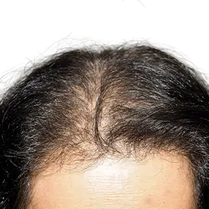 Before After 0