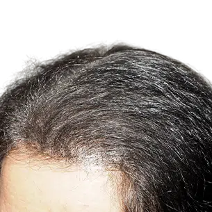 Before After 3