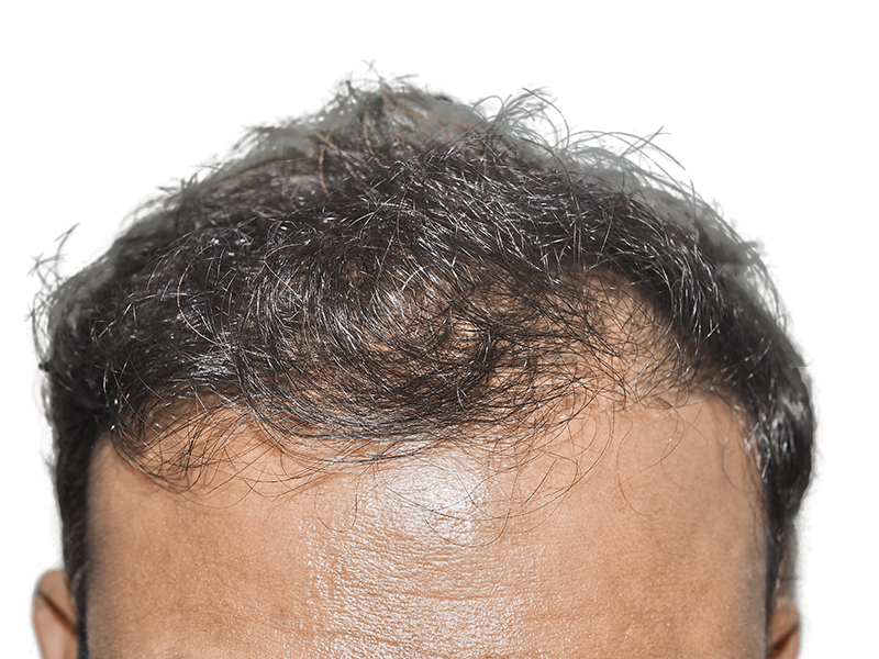 Hair transplant result: Dense, dark hair covers scalp. Successful hair restoration procedure. Before & after transformation.