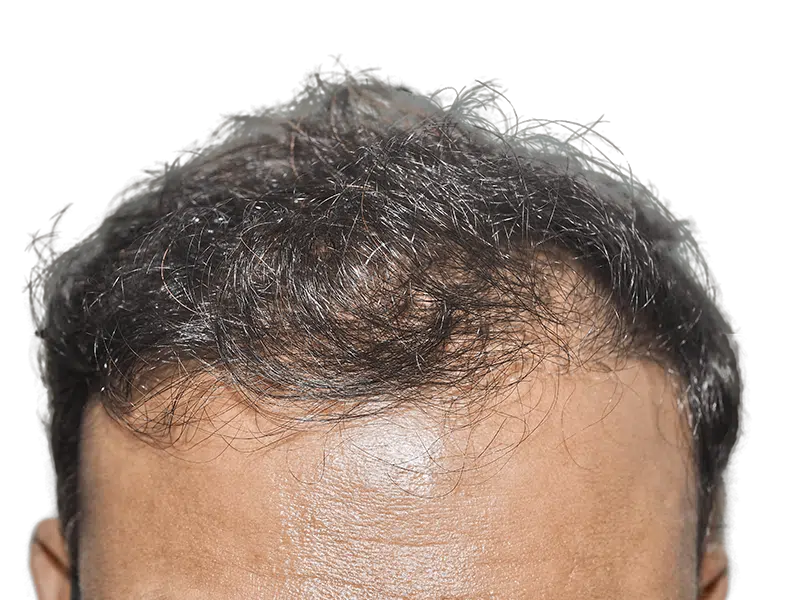 Hair transplant result: Dense, dark hair covers scalp. Successful hair restoration procedure. Before & after transformation.