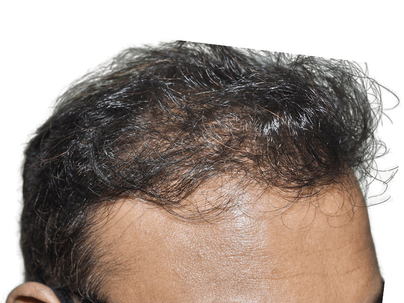 Receding hairline. Consider hair restoration options like hair transplants. Before/after results may vary.