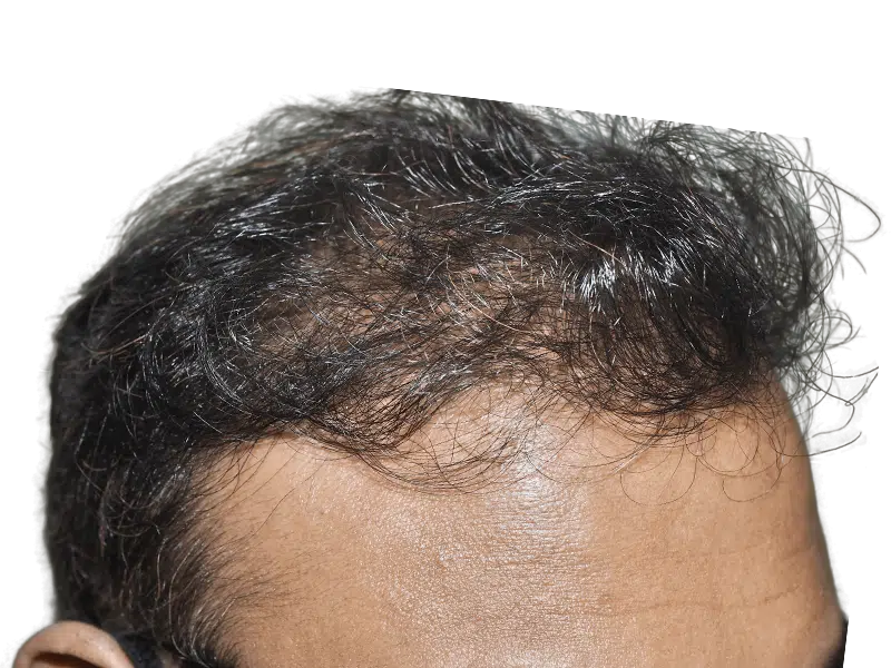 Receding hairline. Consider hair restoration options like hair transplants. Before/after results may vary.