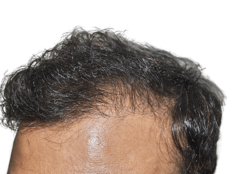 Hair transplant before & after: Asian man with receding hairline, showing restored, fuller hair. Hair restoration results.