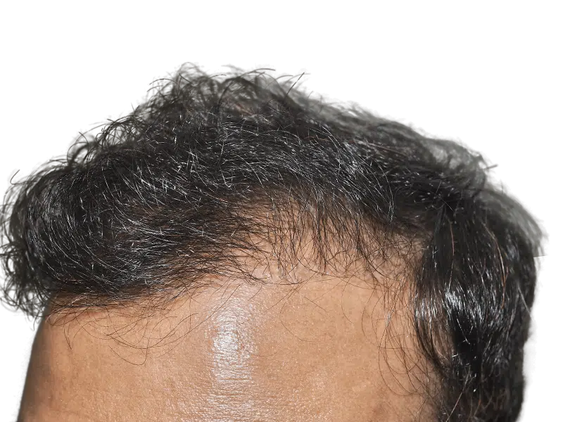 Hair transplant before & after: Asian man with receding hairline, showing restored, fuller hair. Hair restoration results.