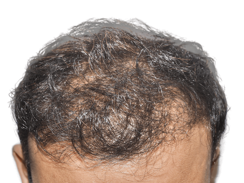 Thinning dark hair, visible scalp. Potential hair loss case for hair restoration or transplant consideration.