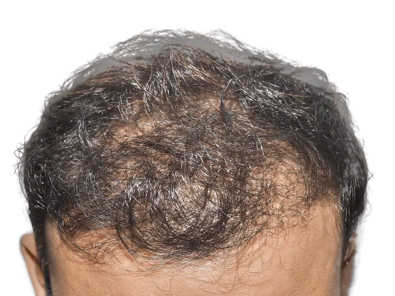 Thinning dark hair, visible scalp. Potential hair loss case for hair restoration or transplant consideration.