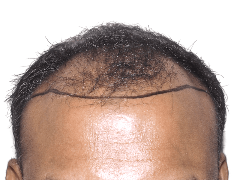 Before hair transplant: Marked hairline on South Asian man. Thinning hair, planning hair restoration procedure.