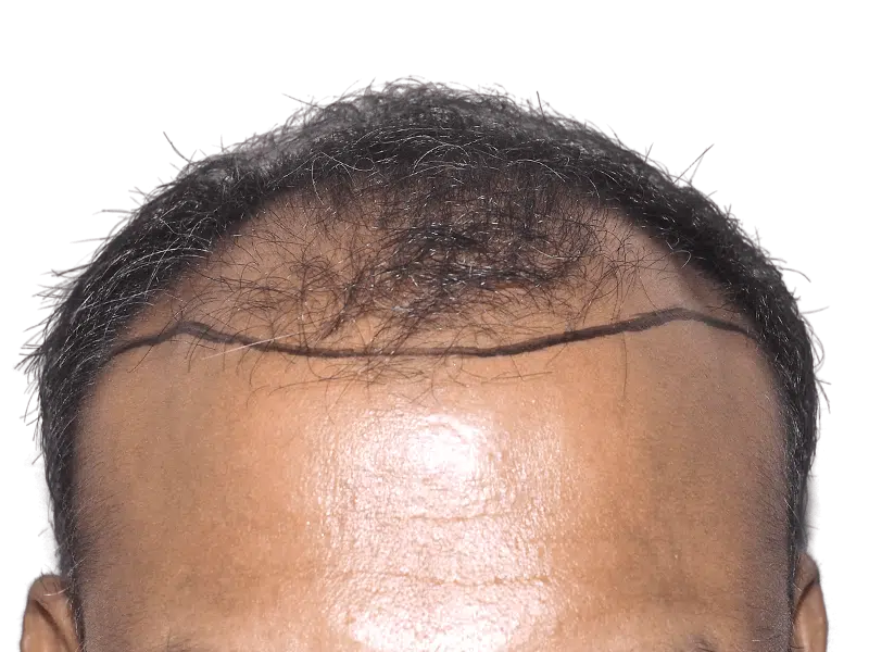 Before hair transplant: Marked hairline on South Asian man. Thinning hair, planning hair restoration procedure.