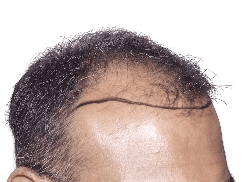 Hair transplant planning: Marked hairline on man with thinning hair. Before & after hair restoration concept.