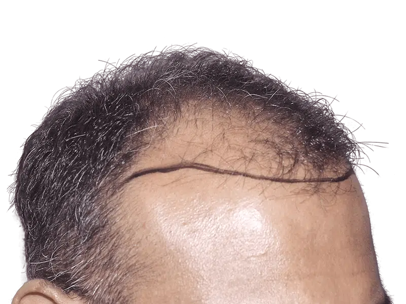 Hair transplant planning: Marked hairline on man with thinning hair. Before & after hair restoration concept.