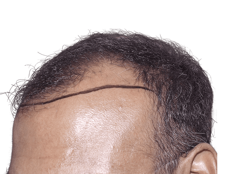 Before hair transplant: Receding hairline marked for restoration. Shows planned hairline. Hair restoration results possible.