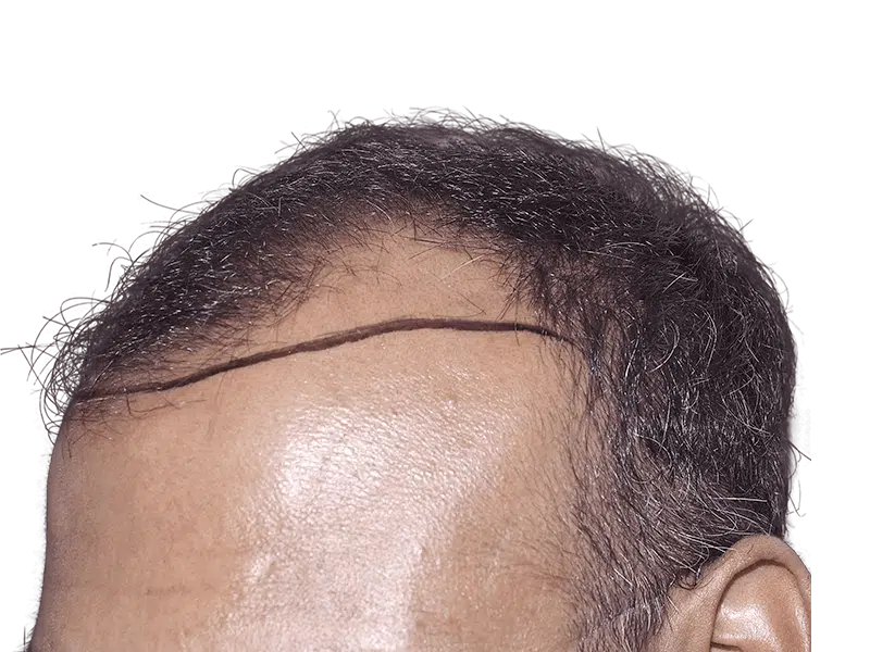 Before hair transplant: Receding hairline marked for restoration. Shows planned hairline. Hair restoration results possible.