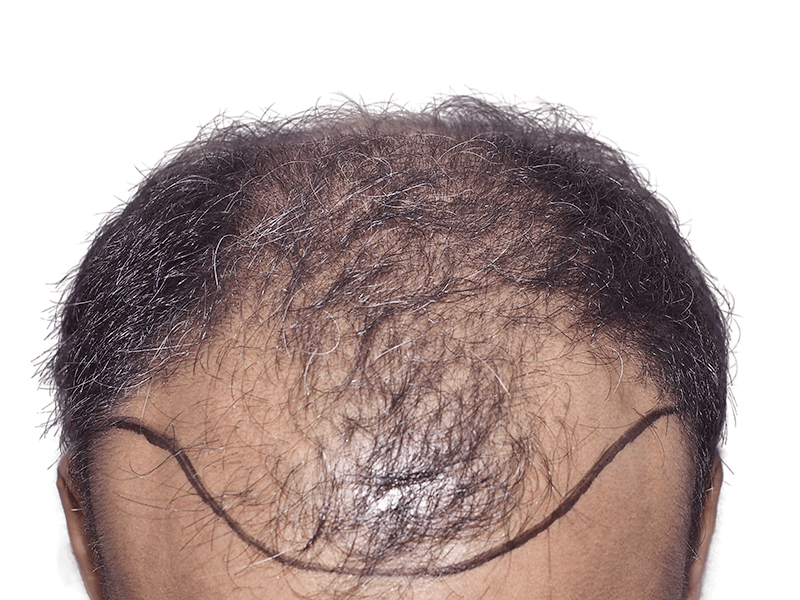 Hair transplant before & after. Graying hair, marked hairline. Thinning to restored density. Hair restoration results.