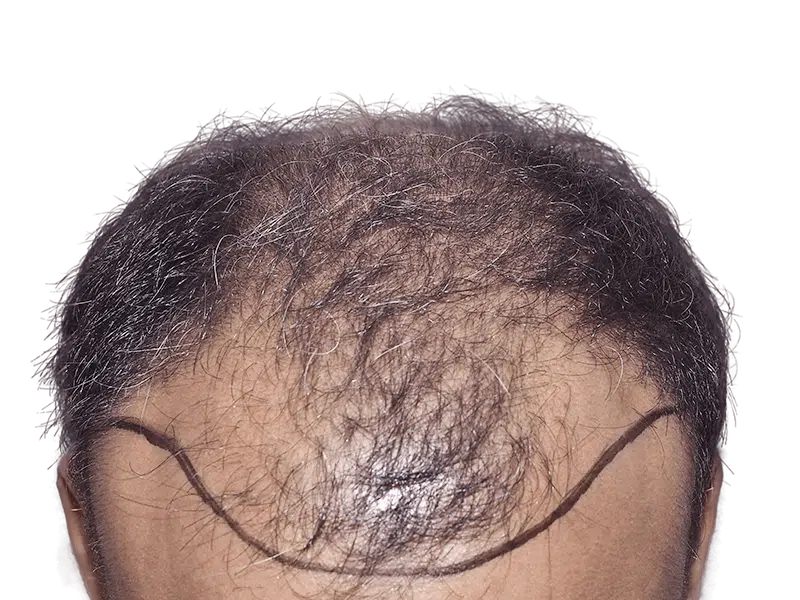 Hair transplant before & after. Graying hair, marked hairline. Thinning to restored density. Hair restoration results.