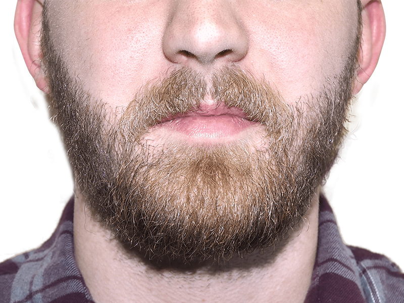 Man with full beard. Beard hair restoration results? Could be a before/after example. Plaid shirt. Blurred background.