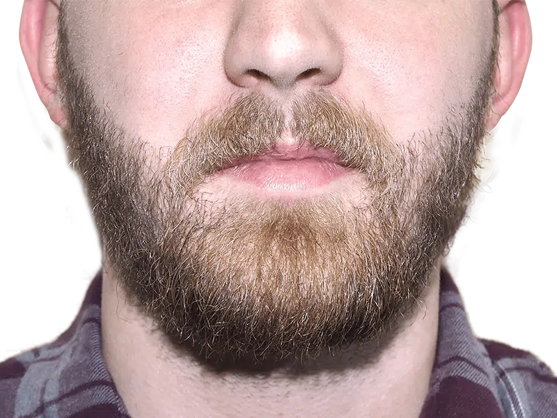 Man with full beard. Beard hair restoration results? Could be a before/after example. Plaid shirt. Blurred background.