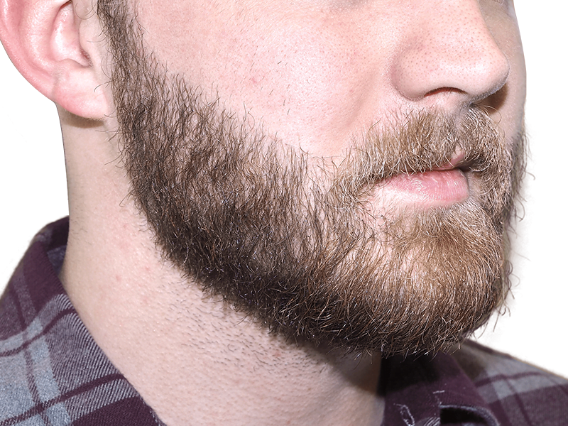Full beard close-up. Hair restoration potential? Untrimmed brown & blonde facial hair. No transplant visible.