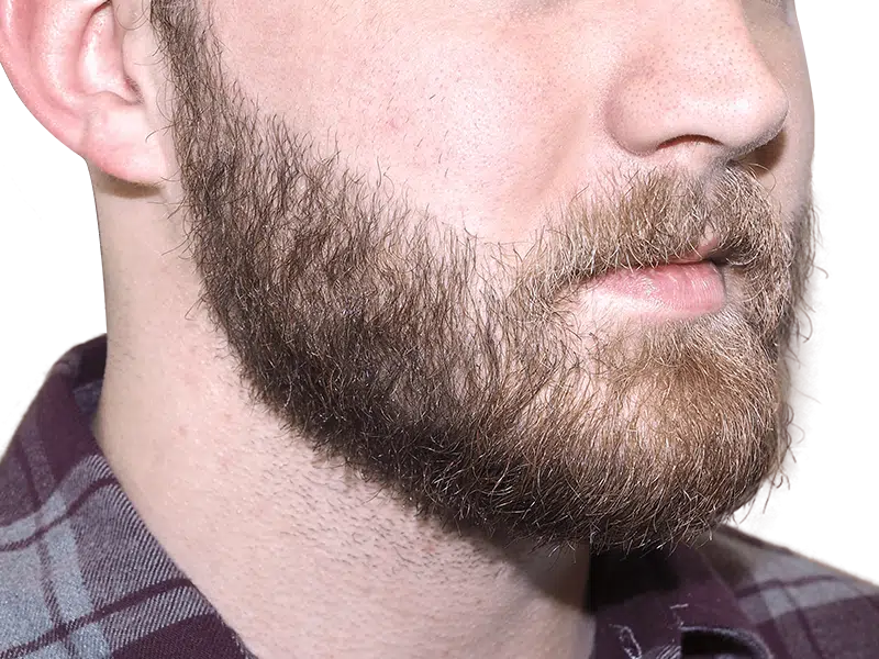 Full beard close-up. Hair restoration potential? Untrimmed brown & blonde facial hair. No transplant visible.