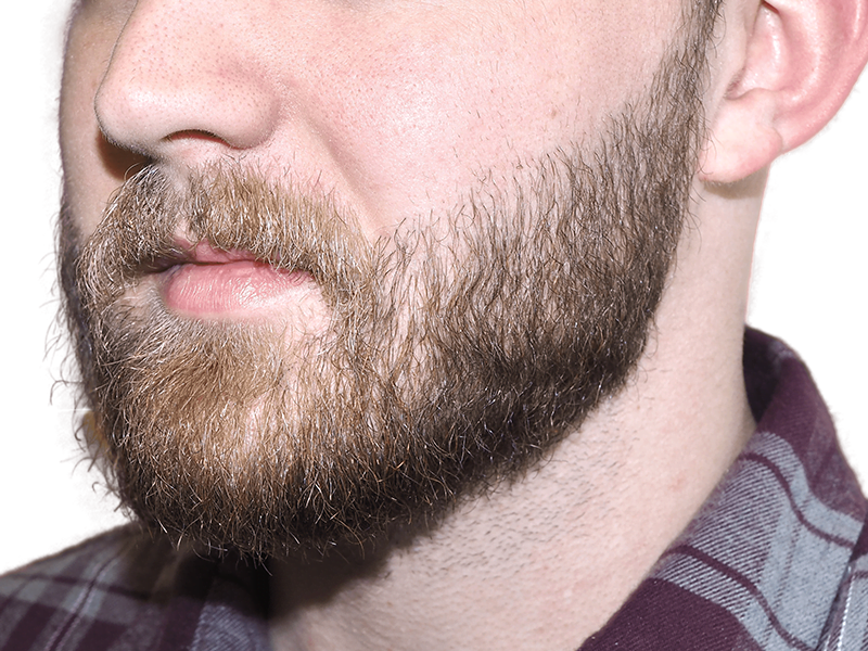 Man with full beard. Could be a candidate for hair transplant or beard restoration. Before/after comparison possible.