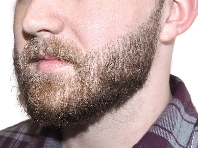 Man with full beard. Could be a candidate for hair transplant or beard restoration. Before/after comparison possible.