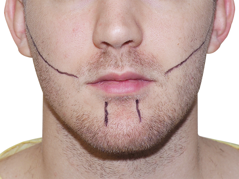Hair transplant planning: Man with facial markings for beard restoration. Consultation for hair loss solution.