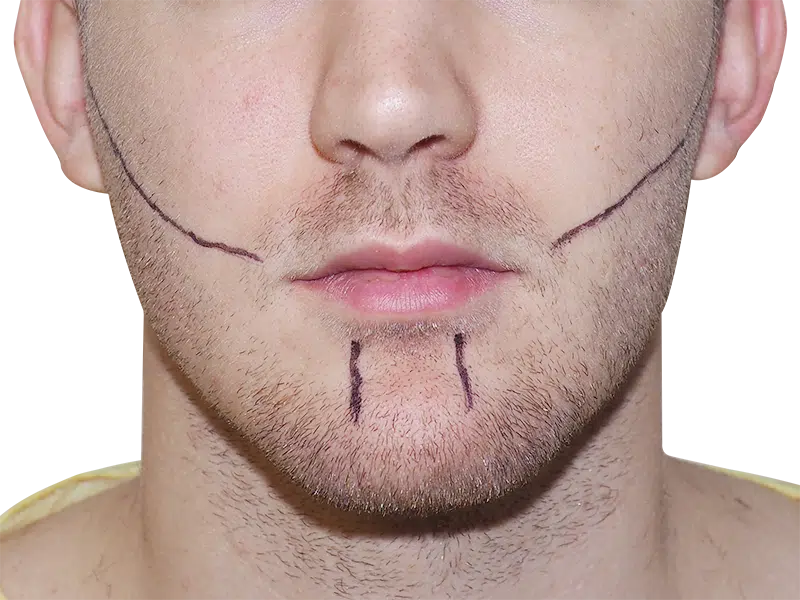 Hair transplant planning: Man with facial markings for beard restoration. Consultation for hair loss solution.
