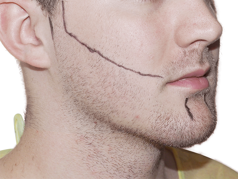 Beard transplant planning: Man with marked jawline for hair restoration. Facial hair enhancement procedure outline shown.