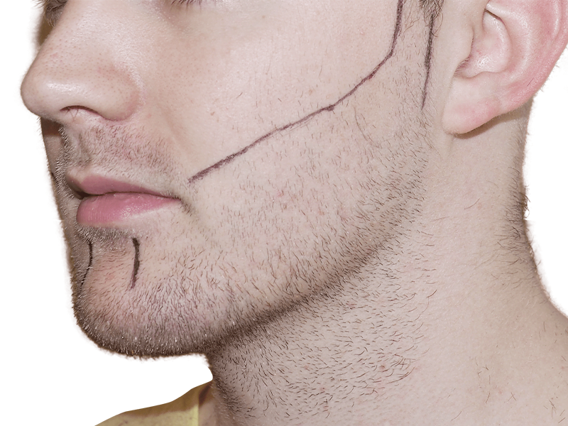 Facial hair transplant planning. Man with markings for beard restoration. Consultation for hair transplant procedure.