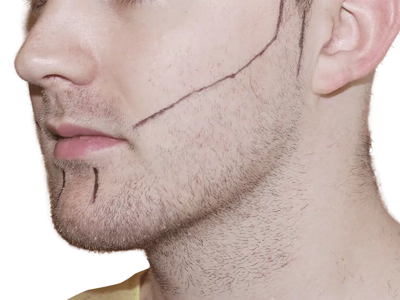 Facial hair transplant planning. Man with markings for beard restoration. Consultation for hair transplant procedure.
