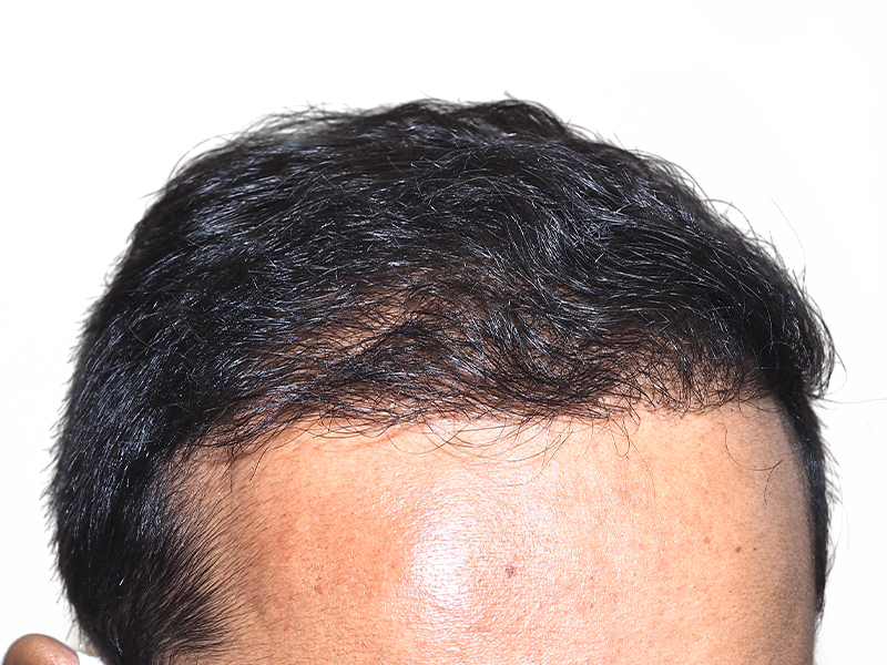 Hair transplant result: Asian man's improved hairline. Before & after hair restoration. Dark, dense hair growth.