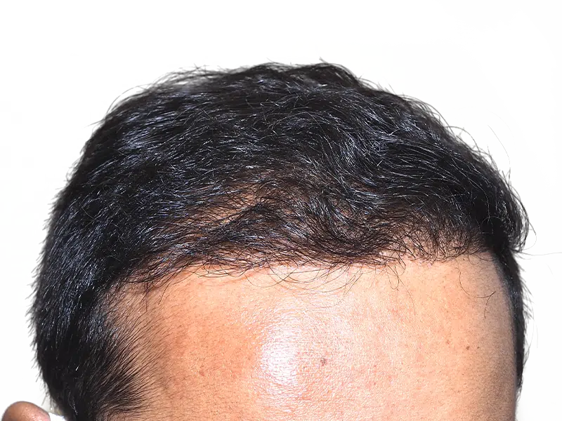 Hair transplant result: Asian man's improved hairline. Before & after hair restoration. Dark, dense hair growth.
