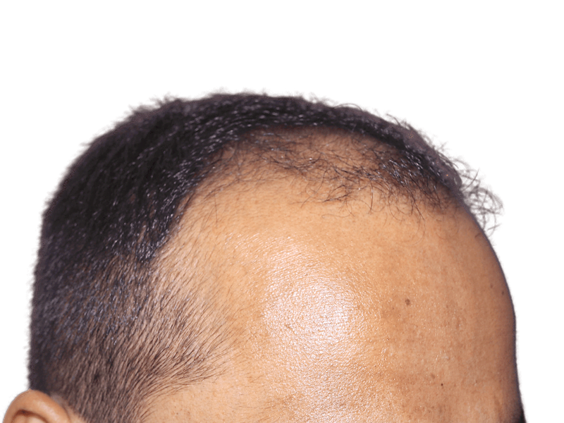 Receding hairline. Potential hair restoration candidate. Thinning hair at the front. Hair transplant before image.