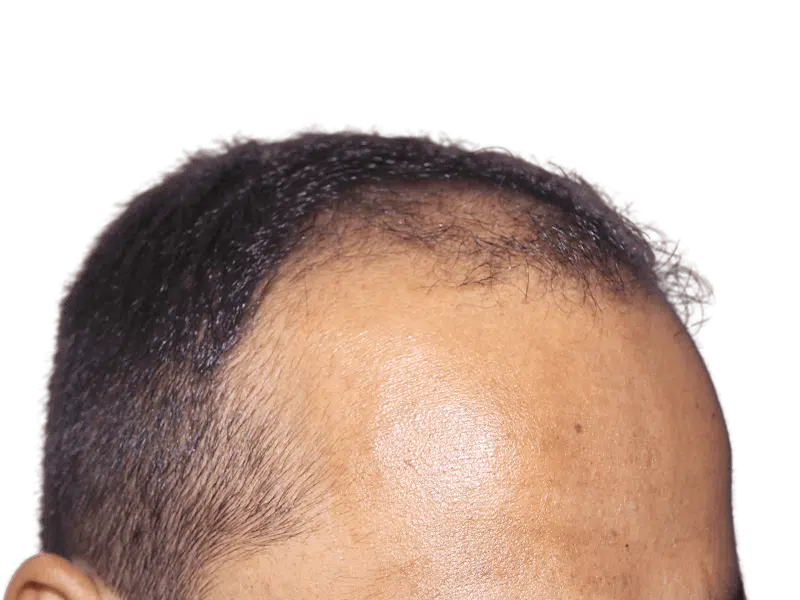 Receding hairline. Potential hair restoration candidate. Thinning hair at the front. Hair transplant before image.