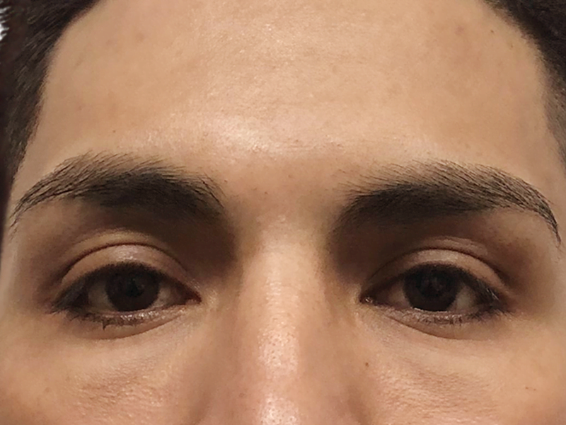 Thick, natural eyebrows frame dark eyes. Potential hair transplant candidate? Focus on eyebrow restoration results.
