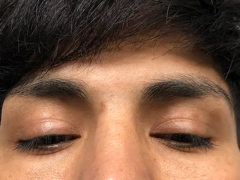 Close-up of dark hair and eyebrows. Potential hair restoration candidate. Before hair transplant assessment.