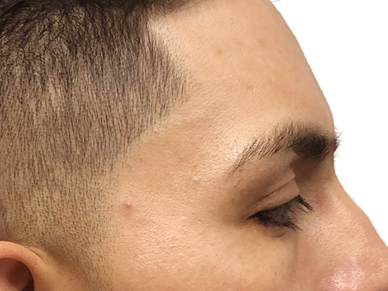 Hairline detail. Dark hair, clean edge. Possible hair transplant candidate. Before/after comparison potential.