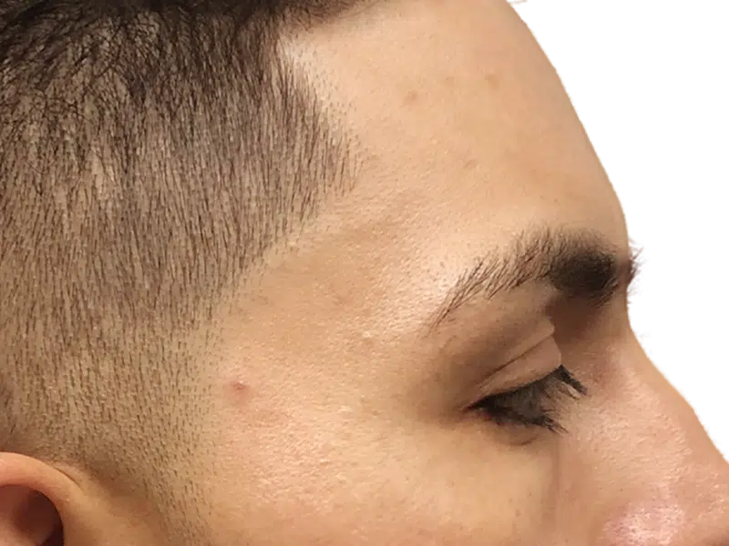 Hairline detail. Dark hair, clean edge. Possible hair transplant candidate. Before/after comparison potential.