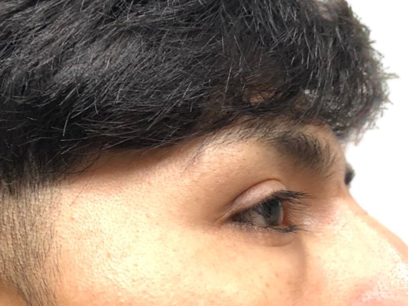 Dark hair, styled hairline. Potential hair restoration candidate. Before/after hair transplant consultation. Close-up portrait.