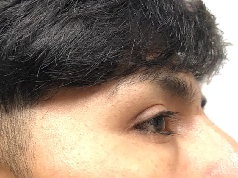 Dark hair, styled hairline. Potential hair restoration candidate. Before/after hair transplant consultation. Close-up portrait.