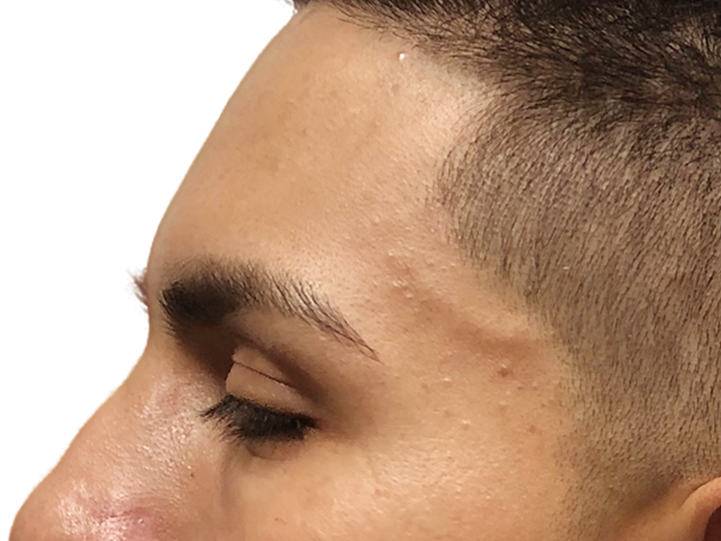 Hair restoration candidate. Dark hair, closely cropped. Could be a hair transplant before/after. Side profile.
