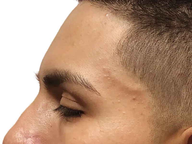 Hair restoration candidate. Dark hair, closely cropped. Could be a hair transplant before/after. Side profile.
