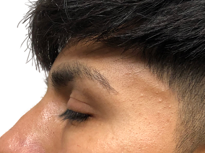 Hair transplant result: Asian man's improved hairline. Before & after hair restoration procedure. Close-up, side profile.