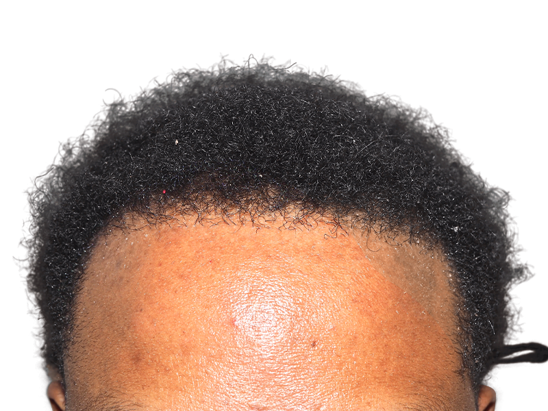 Hair transplant result: African American man's restored hairline. Natural, dense hair growth after procedure. Hair restoration success.